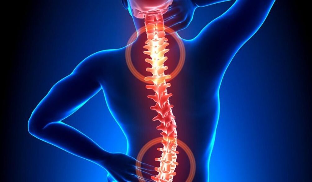 Οστεοχόνδρωση της σπονδυλικής στήλης