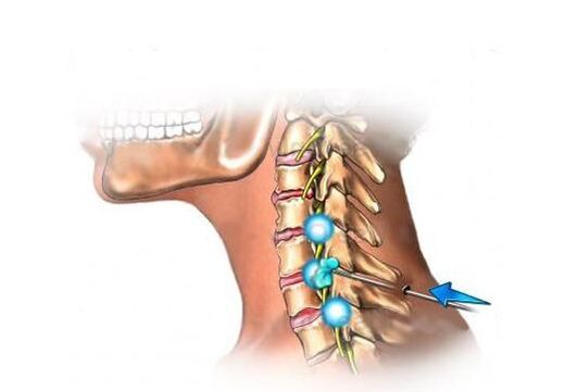 Θεραπεία της οστεοχονδρωσίας του τραχήλου της μήτρας